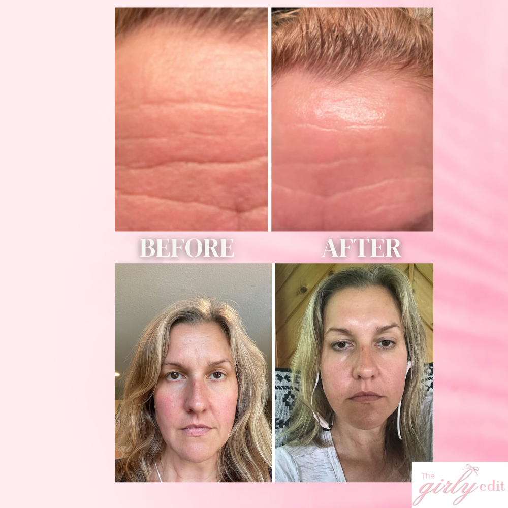 WrinkleLift Tape: The Secret to Smoother, Youthful Skin